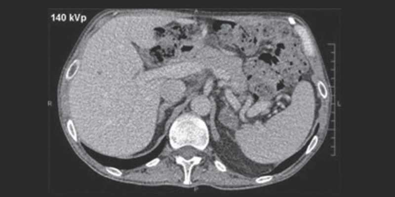CT Triphasic Spiral