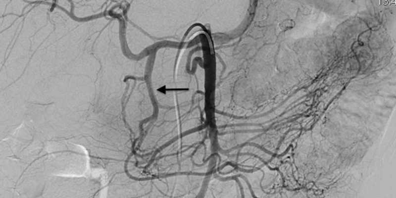 RENAL ANGIOGRAPHY