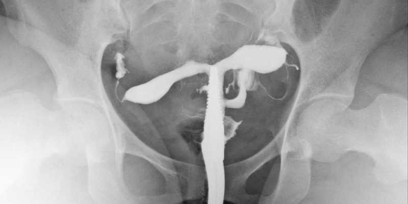 X-Ray HSG