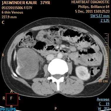 Xantho-granulomatous pyelonephritis
