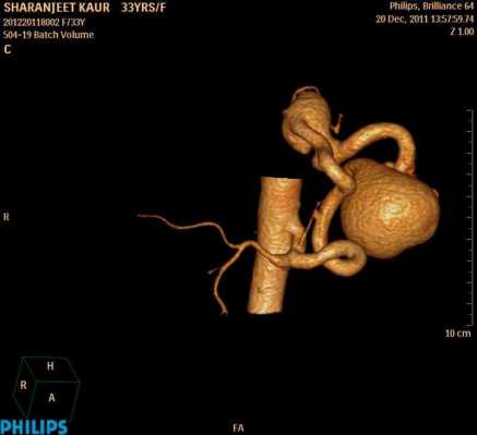 Splenic AVM (3D)