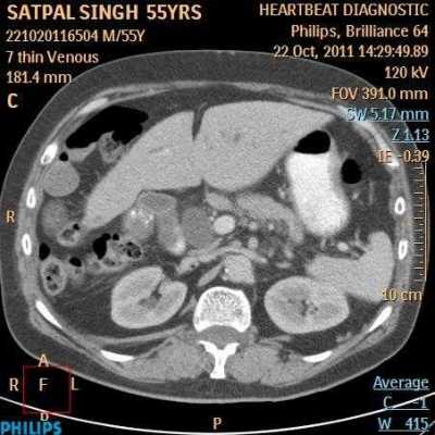 Hydatid Cyst